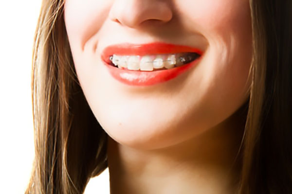 Benefits Of Clear Braces Versus Traditional Ones