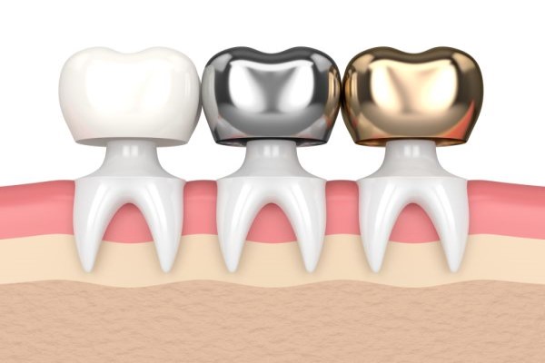 Ask A Cosmetic Cosmetic &#    ; Same Day Crowns Vs Traditional Crowns