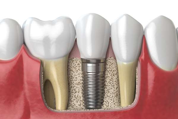 Dental Implants for Replacing Missing Teeth from Highlands Family Dentistry in Dallas, TX