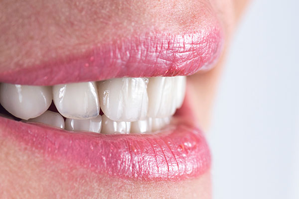 How To Prevent Cavities Under Veneers from Highlands Family Dentistry in Dallas, TX