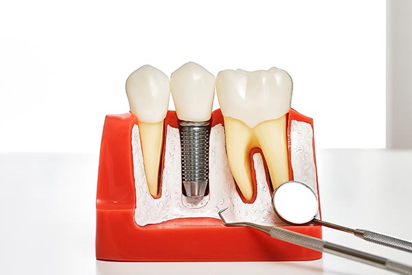 Your Guide to Different Kinds of Dental Implants from Highlands Family Dentistry in Dallas, TX