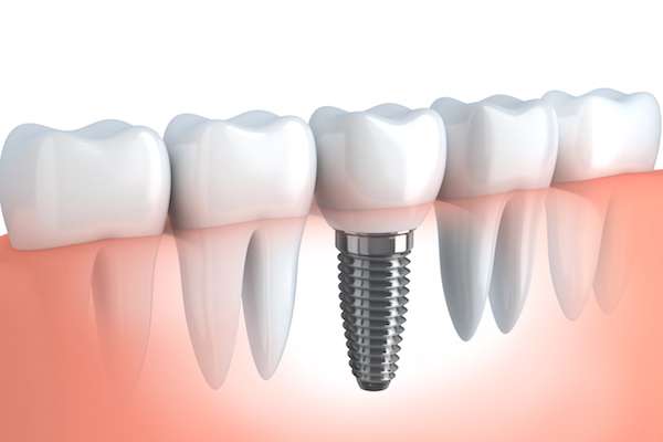 Your Ultimate Guide to Getting Dental Implants from Highlands Family Dentistry in Dallas, TX
